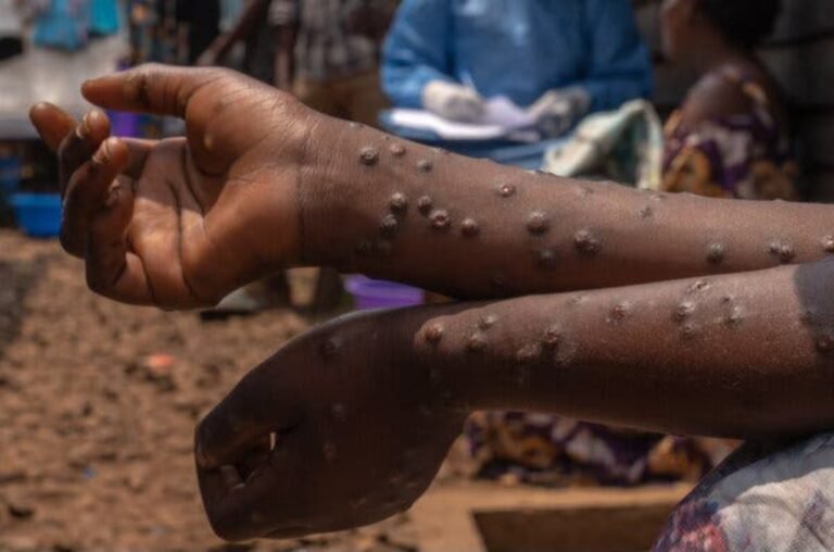 Épidémie de Mpox en Guinée : bilan préoccupant avec 381 cas confirmés